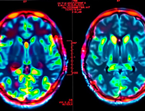 New MRI Study Reveals How Cannabis Alters Brain Activity and Weakens Memory